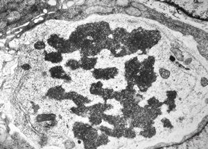 F,35y. | mitosis - intestine, celiakia F,35y. | mitosis - intestine, celiakia